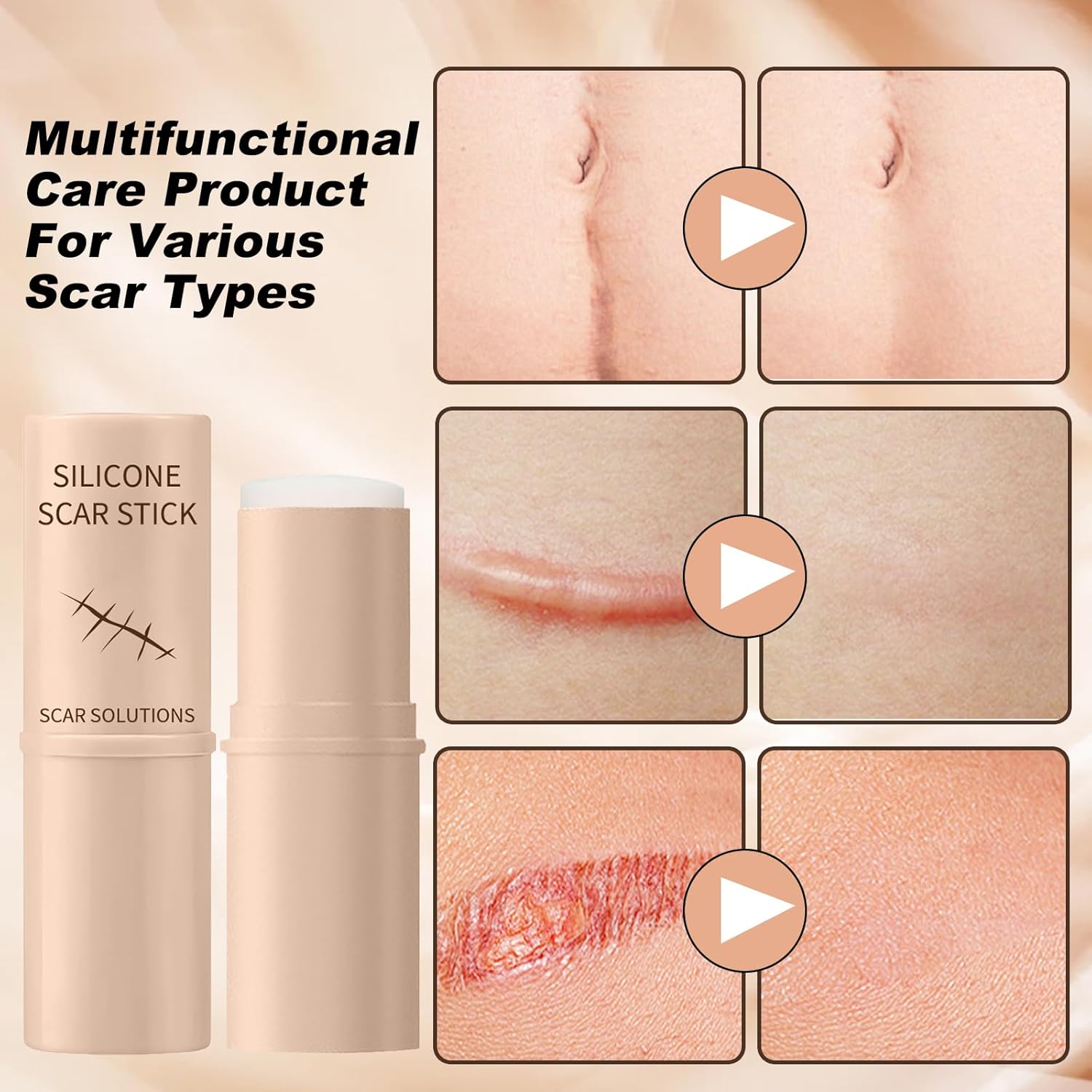Silicon Scar Stick